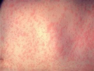 Global measles cases nearly doubled in one year, researchers say