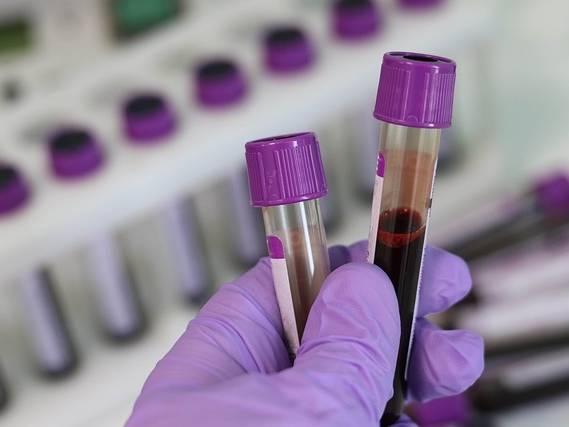 ‘Transformative’ sickle cell treatment approved for NHS use